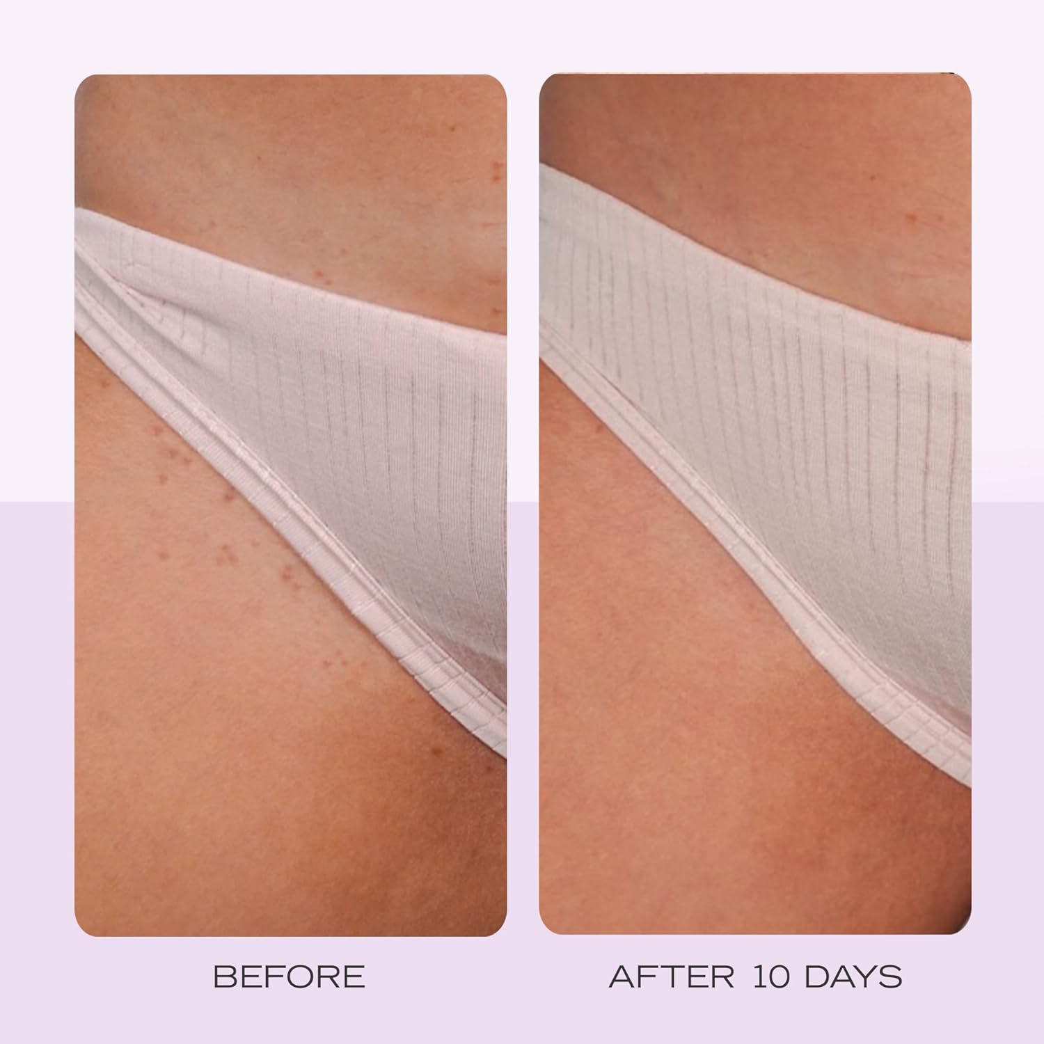 Ingrown Hair Pads – 28 Ct BHA+AHA, Razor Treatment